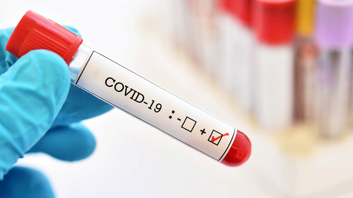 COVID-19 PCR teszt árak